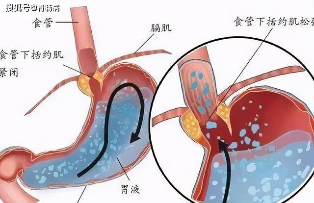 胃酸吃什么能缓解