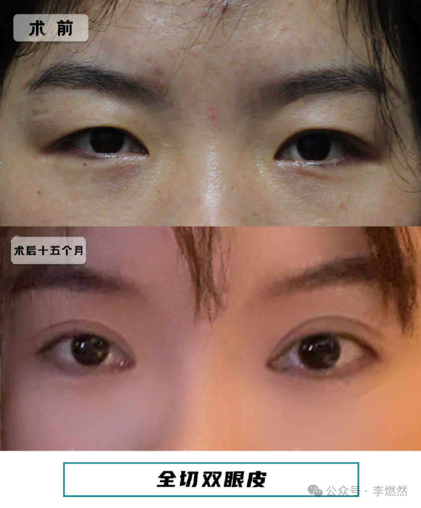 割双眼皮多少钱