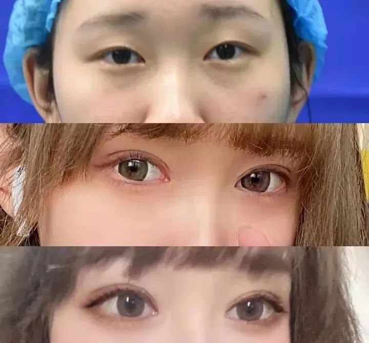 割双眼皮多少钱