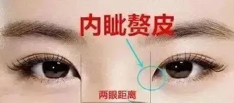 割双眼皮多少钱