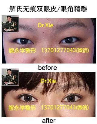 割双眼皮多少钱